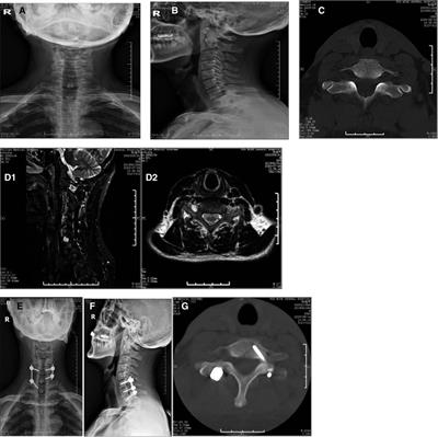 Case Report: Microscope-assisted surgery of C7 nerve root cyst with neurological symptoms